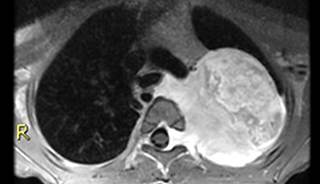 ‘Excellent’ Survival in Biology-based Pediatric Neuroblastoma Treatment Reduction ‘Excellent’ Survival in Biology-based Pediatric Neuroblastoma Treatment Reduction