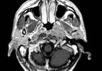 No benefits from neoadjuvant gemcitabine + carboplatin + paclitaxel in nasopharyngeal cancer No benefits from neoadjuvant gemcitabine + carboplatin + paclitaxel in nasopharyngeal cancer