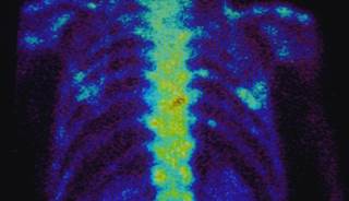 Less Frequent Zoledronic Acid for Bone Metastases Safe, Effective Less Frequent Zoledronic Acid for Bone Metastases Safe, Effective