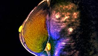 An abbreviated magnetic resonance imaging protocol can exclude malignancy in women with suspicious X-ray mammography screening. An abbreviated magnetic resonance imaging protocol can exclude malignancy in women with suspicious X-ray mammography screening.