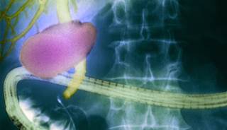 Adjuvant Chemotherapy in Periampullary Adenocarcinoma Adjuvant Chemotherapy in Periampullary Adenocarcinoma