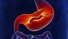 Treatment of <i>H. pylori</i> Increased Platelet Count in ITP Treatment of <i>H. pylori</i> Increased Platelet Count in ITP