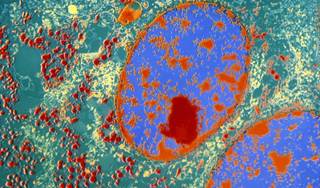 Novel Therapy May Be Effective for Neuroendocrine Tumors Novel Therapy May Be Effective for Neuroendocrine Tumors