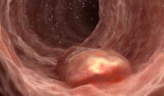 Narrow Band Imaging May mprove Detection of Colorectal Adenomas and Polyps Narrow Band Imaging May mprove Detection of Colorectal Adenomas and Polyps