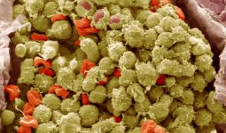 For Chronic Lymphocytic Lymphoma (CLL) and Mantle Cell Lymphoma (MCL), Ibrutinib Plus ABT-199 may be For Chronic Lymphocytic Lymphoma (CLL) and Mantle Cell Lymphoma (MCL), Ibrutinib Plus ABT-199 may be