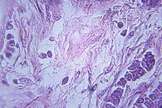 Palbociclib Doubles PFS in Women with Advanced Breast Cancer Palbociclib Doubles PFS in Women with Advanced Breast Cancer