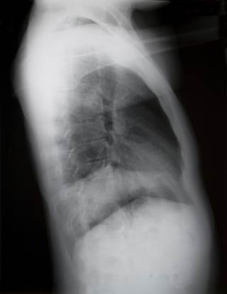 Mesothelioma: No Cure Yet, But Much Promise in New Therapies Mesothelioma: No Cure Yet, But Much Promise in New Therapies