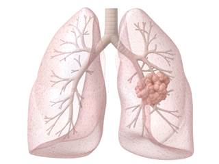 For Advanced Non-Small Cell Lung Cancer (NSCLC), Nintedanib Improves Overall Survival Without Reduci For Advanced Non-Small Cell Lung Cancer (NSCLC), Nintedanib Improves Overall Survival Without Reduci