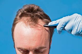 A recent study links male pattern baldness with elevated risk of aggressive prostate cancer. A recent study links male pattern baldness with elevated risk of aggressive prostate cancer.