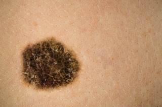 Update on future developments for patients with metastatic melanoma with and without BRAF mutations. Update on future developments for patients with metastatic melanoma with and without BRAF mutations.