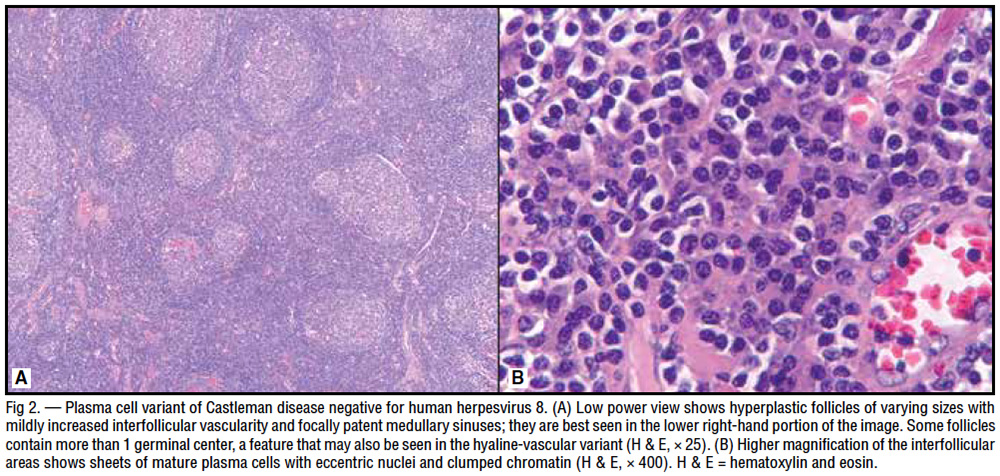 Diagnosis and Management of Castleman Disease - Cancer Therapy Advisor