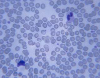 Blinatumomab resulted in complete minimal residual disease (MRD) in 78% of patients with ALL. Blinatumomab resulted in complete minimal residual disease (MRD) in 78% of patients with ALL.