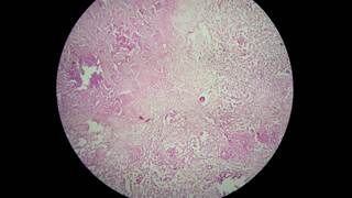 LDVP Regimen Following Radiotherapy Effective for Stage III/IV T-Cell Lymphoma LDVP Regimen Following Radiotherapy Effective for Stage III/IV T-Cell Lymphoma