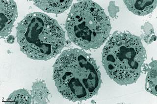 Researchers analyzed human AML samples to determine potential selective targets in leukemia stem cells, the source of resistance to standard chemotherapy. Researchers analyzed human AML samples to determine potential selective targets in leukemia stem cells, the source of resistance to standard chemotherapy.