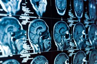 Phase 2 studies show in vitro effectiveness in various glioblastoma multiforme cell lines. Phase 2 studies show in vitro effectiveness in various glioblastoma multiforme cell lines.