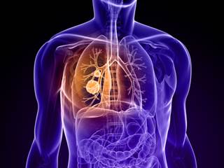 A phase II trial shows promise for patients with extensive small cell lung cancer who currently have limited treatment options. A phase II trial shows promise for patients with extensive small cell lung cancer who currently have limited treatment options.