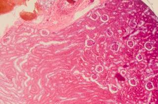 This fact sheet for patients reviews the cause, symptoms, tests, and prognosis for renal cell carcinoma/kidney cancer. This fact sheet for patients reviews the cause, symptoms, tests, and prognosis for renal cell carcinoma/kidney cancer.