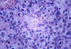 Novel Imaging Techniques May Eliminate Need for Renal Mass Biopsy for Locally-advanced RCC Novel Imaging Techniques May Eliminate Need for Renal Mass Biopsy for Locally-advanced RCC