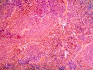 Ruxolitinib plus capecitabine may improve survival in patients with metastatic pancreatic cancer and systemic inflammation. Ruxolitinib plus capecitabine may improve survival in patients with metastatic pancreatic cancer and systemic inflammation.