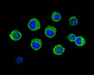 Treatment with amonafide L-malate in combination with cytarabine did not improve response rate in secondary AML. Treatment with amonafide L-malate in combination with cytarabine did not improve response rate in secondary AML.