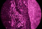 Inotuzumab Ozogamicin Active in Heavily Pretreated Indolent B-cell NHL Inotuzumab Ozogamicin Active in Heavily Pretreated Indolent B-cell NHL