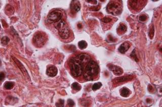 Combination of brentuximab vedotin with bendamustin is effective in Hodgkin lymphoma and anaplastic large T-cell lymphoma. Combination of brentuximab vedotin with bendamustin is effective in Hodgkin lymphoma and anaplastic large T-cell lymphoma.
