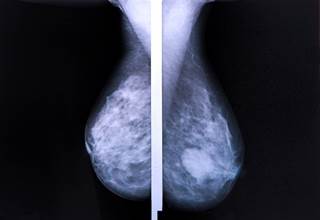 PAM50 risk of recurrence score and intrinsic subtype may be able to identify node-positive breast ca PAM50 risk of recurrence score and intrinsic subtype may be able to identify node-positive breast ca