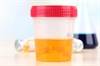 CKD Progression Tied to Low Potassium Excretion CKD Progression Tied to Low Potassium Excretion