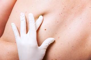 Individuals who have many moles are at increased risk for melanoma skin cancer. Individuals who have many moles are at increased risk for melanoma skin cancer.