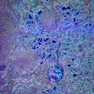 There are various recurrent mutations associated with chemo-immunotherapy relapse in patients with diffuse large B-cell lymphoma. There are various recurrent mutations associated with chemo-immunotherapy relapse in patients with diffuse large B-cell lymphoma.