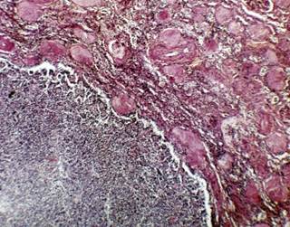 Overall, 3.5 million cells were analyzed and 17 major tumor-associated macrophage phenotypes were identified. Overall, 3.5 million cells were analyzed and 17 major tumor-associated macrophage phenotypes were identified.