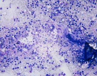 In patients with myelofibrosis treated with ruxolitinib, harboring three or more mutations was inversely associated with response. In patients with myelofibrosis treated with ruxolitinib, harboring three or more mutations was inversely associated with response.