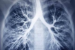 Maintenance pembrolizumab does not prolong progression-free survival, though it may improve overall survival, among patients with extensive-stage small-cell lung cancer. Maintenance pembrolizumab does not prolong progression-free survival, though it may improve overall survival, among patients with extensive-stage small-cell lung cancer.