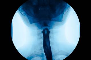 The addition of radiotherapy to neoadjuvant chemotherapy improved histological complete response rate, The addition of radiotherapy to neoadjuvant chemotherapy improved histological complete response rate,