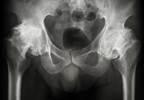 Active Surveillance Reasonable for Small, Low-Grade Bladder Tumors Active Surveillance Reasonable for Small, Low-Grade Bladder Tumors