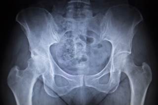 Detection of occult bone metastases can be critical in determining the management of patients with renal cell carcinoma. Detection of occult bone metastases can be critical in determining the management of patients with renal cell carcinoma.