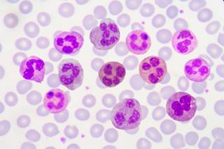 Researchers have established a core long non-coding RNA (lncRNA) stem cell signature in acute myeloid leukemia. Researchers have established a core long non-coding RNA (lncRNA) stem cell signature in acute myeloid leukemia.
