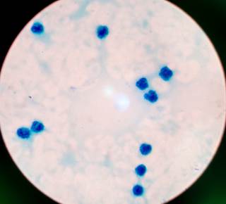 Researchers have developed a novel prognostic framework based on comprehensive genomic that predicts risk acute myeloid leukemia. Researchers have developed a novel prognostic framework based on comprehensive genomic that predicts risk acute myeloid leukemia.
