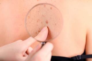 Immune-related perturbation may contribute to development of melanoma in survivors of some forms of NHL. Immune-related perturbation may contribute to development of melanoma in survivors of some forms of NHL.