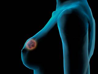 Sequential anthracycline cyclophosphamide and taxane (AC-T) was likely to be the most effective adjuvant therapy for early stage breast cancer. Sequential anthracycline cyclophosphamide and taxane (AC-T) was likely to be the most effective adjuvant therapy for early stage breast cancer.