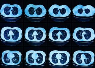 Study finds lung cancer patients miss critical diagnostic tests and often wait too long for treatment. Study finds lung cancer patients miss critical diagnostic tests and often wait too long for treatment.