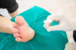 Acute peripheral neuropathy often does not resolve between cycles of treatment and severity often increases between cycles. Acute peripheral neuropathy often does not resolve between cycles of treatment and severity often increases between cycles.