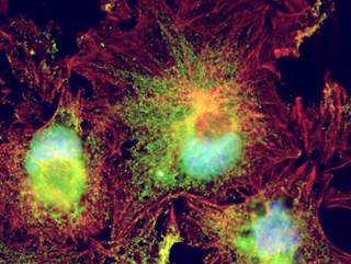 Risk of sentinel lymph node positivity was significantly lower in patients with melanoma with histologic regression. Risk of sentinel lymph node positivity was significantly lower in patients with melanoma with histologic regression.