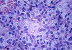 Karyopherin a2 May Be Prognostic Indicator in Renal Cell Carcinoma Karyopherin a2 May Be Prognostic Indicator in Renal Cell Carcinoma
