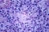 Karyopherin a2 May Be Prognostic Indicator in Renal Cell Carcinoma Karyopherin a2 May Be Prognostic Indicator in Renal Cell Carcinoma