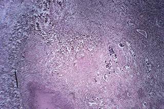 Stereotactic body radiation therapy is linked to improved survival in elderly patients with early stage non-small cell lung cancer. Stereotactic body radiation therapy is linked to improved survival in elderly patients with early stage non-small cell lung cancer.