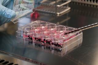 Study findings demonstrated that germline variation influences the development of bone disease in patients with multiple myeloma. Study findings demonstrated that germline variation influences the development of bone disease in patients with multiple myeloma.