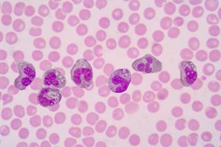 Neutrophil-to-lymphocyte ratio may be a strong predictor of overall survival in head and neck carcinomas. Neutrophil-to-lymphocyte ratio may be a strong predictor of overall survival in head and neck carcinomas.