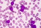 Coping With Non-Hodgkin Lymphoma Coping With Non-Hodgkin Lymphoma