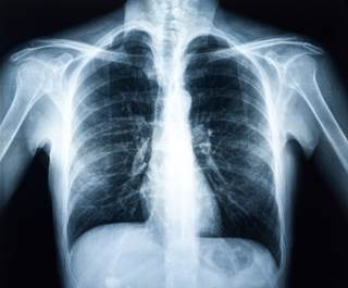 Belagenpumatucel-L as maintenance therapy for non-small cell lung cancer may benefit patients. Belagenpumatucel-L as maintenance therapy for non-small cell lung cancer may benefit patients.